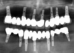 Dental Implant