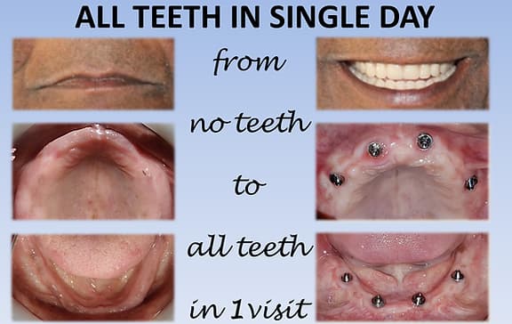 Dental Implant
