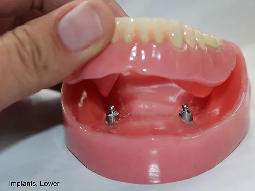 Dental Implant