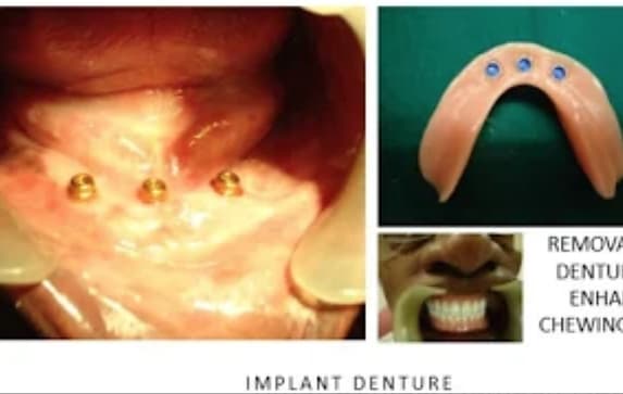 Dental Implant