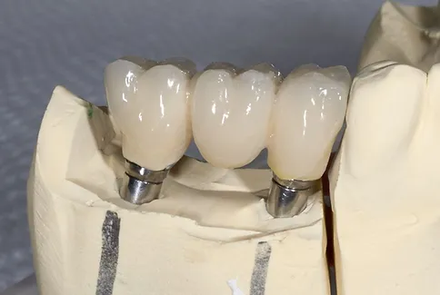Dental Implant