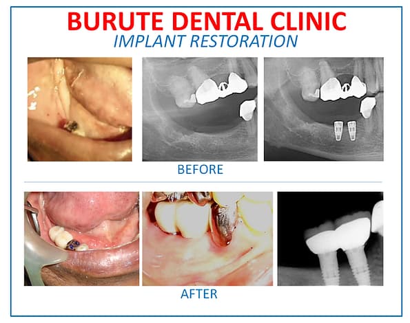 Dental Implant