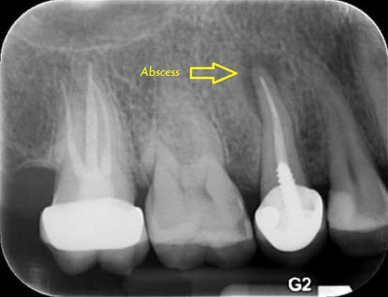Dental Implant