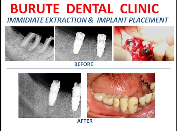 Dental Implant