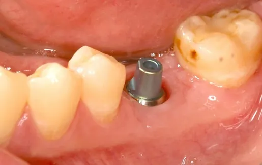 Dental Implant
