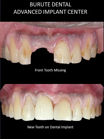 Dental Implant